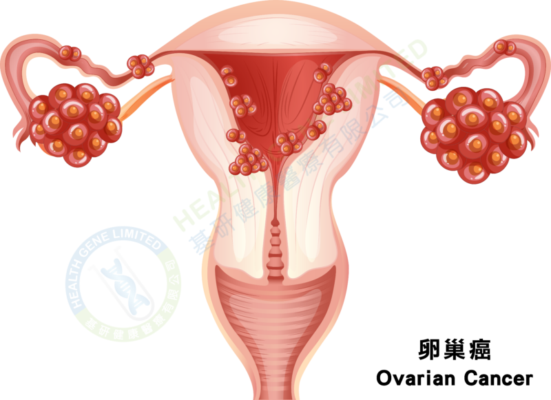 卵巢腫瘤, ovarian tumour, ovarian cancer