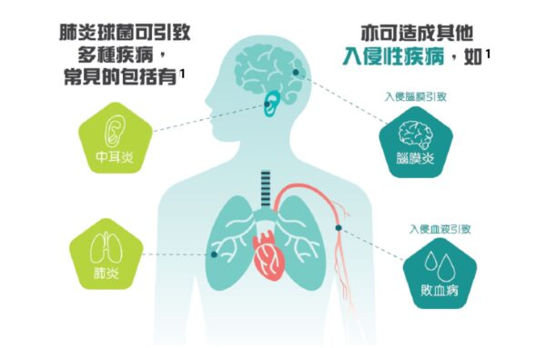 肺炎球菌可引致