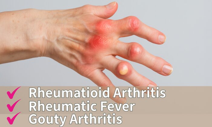風濕性關節炎檢查Rheumatoid arthritis